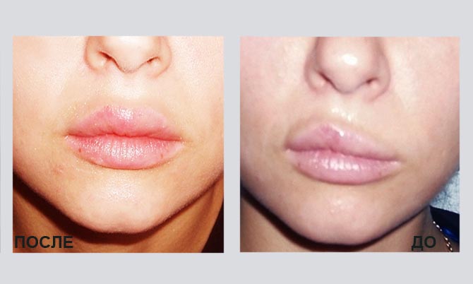Білі точки на губах після збільшення губ |  Вілента - косметичні
